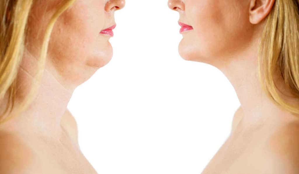 Double Chin treatment Kent before and after results