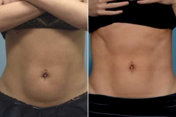 body sculpting FAQs Kent
