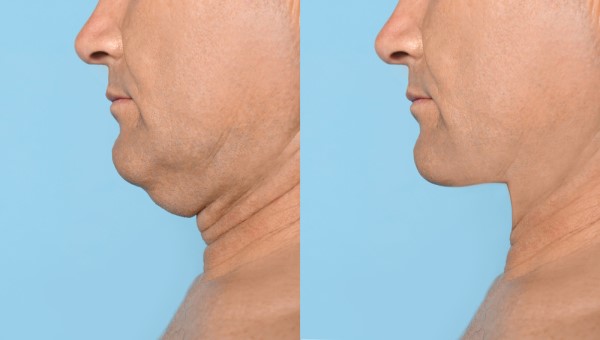 Which Non-Surgical Treatments Work Best for Jowls and Loose Skin Kent?