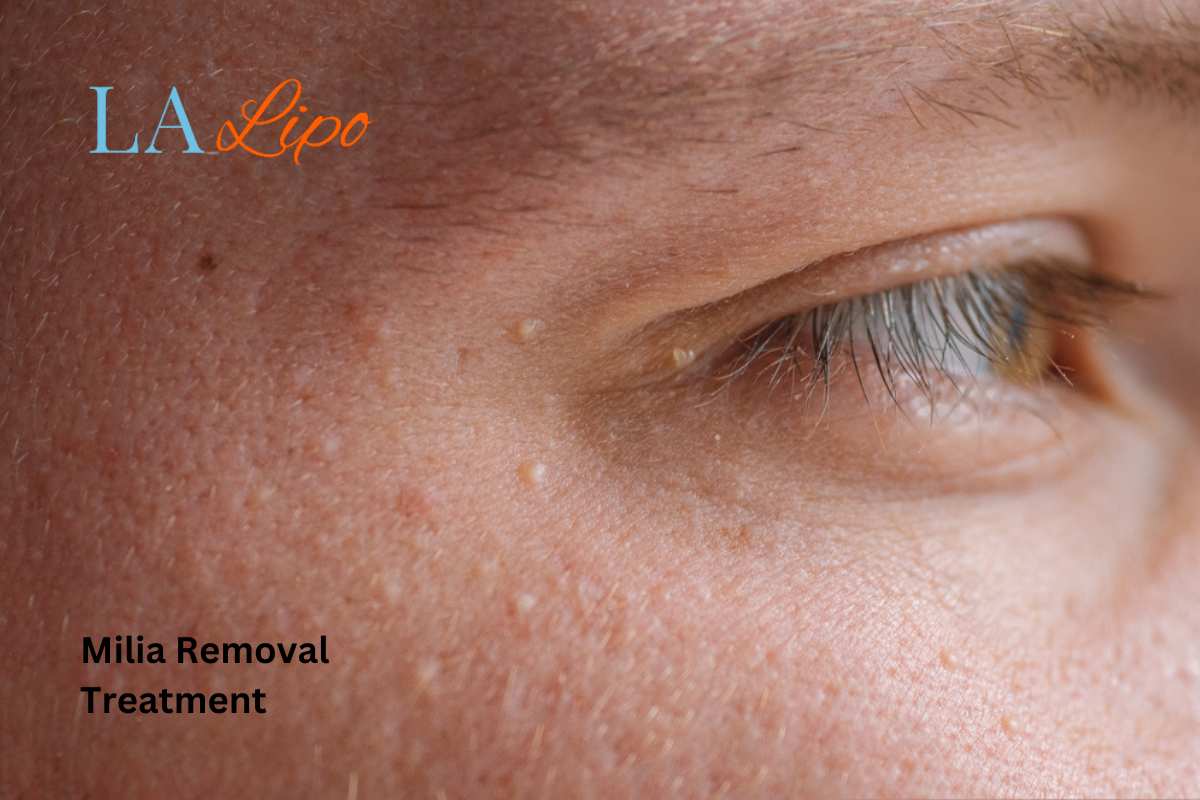 Cryopen Milia Removal: Is It the Easiest and Safest Option Kent?