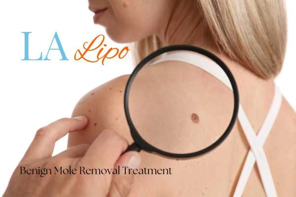 Woman having her inspection of blemish before mole removal Kent