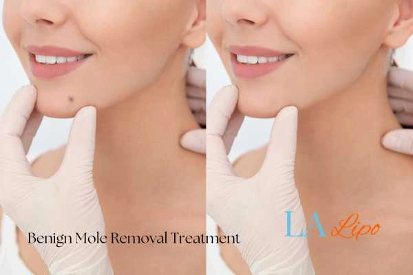 Before and after mole removal Kent treatment