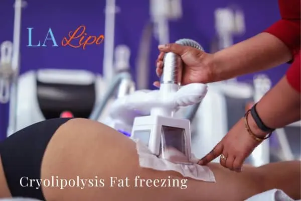 women getting fat freezing Kent