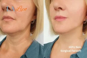 hi-fu for wrinkles Kent before and after results