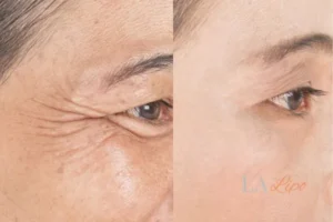 Before and after results of woman - HI-fu wrinkles reduction treatment Kent