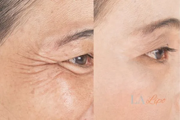 Before and after results of woman - HI-fu wrinkles reduction treatment Kent