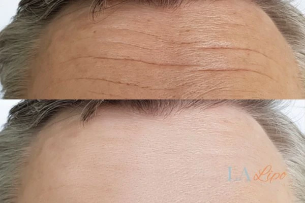 results of HIFU Kent on mans forehead to help reduce lines and wrinkles