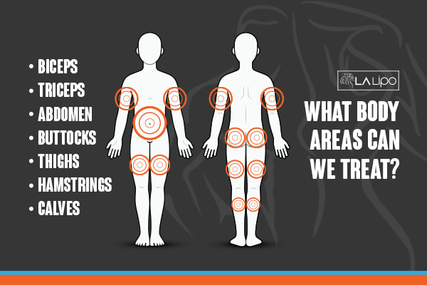 Graphic to show areas you can have LA-EMS Body Sculpting Kent treatment.