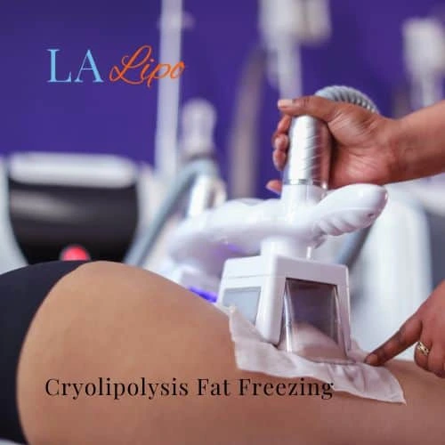 fat freezing - Cryolipolysis Kent