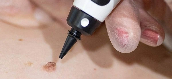skin tag removal using cryopen Kent