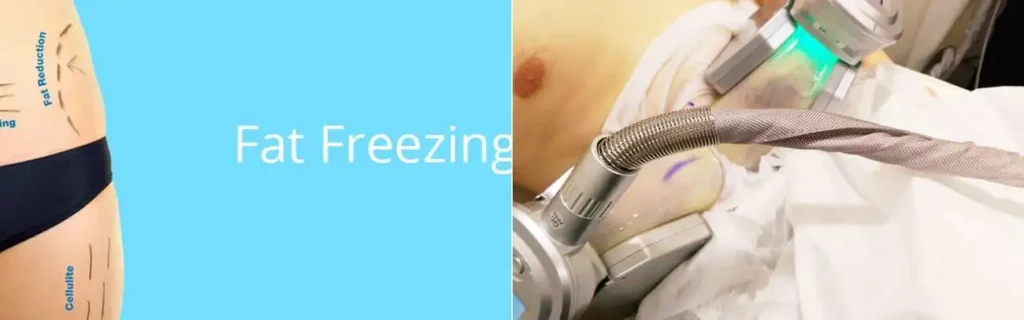 multi areas of a persons body having coolsculpting Kent treatment