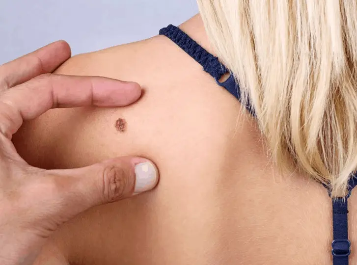 woman having mole removal Kent consultation before treatment.