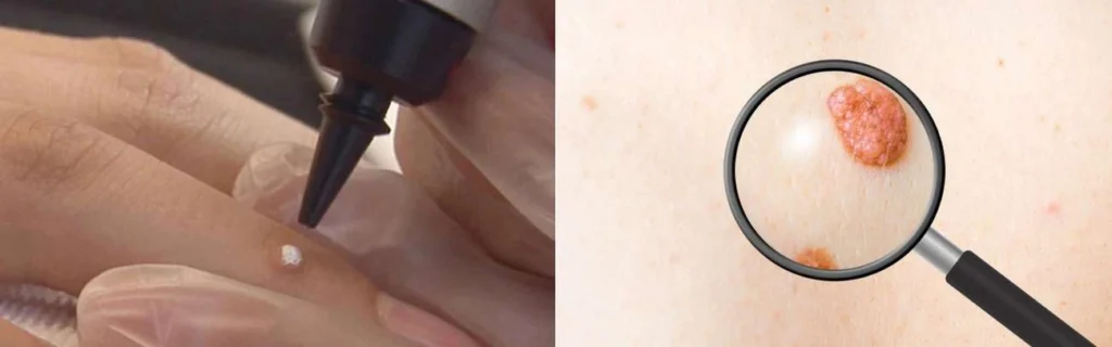 Person getting moles removed with cryopen Kent