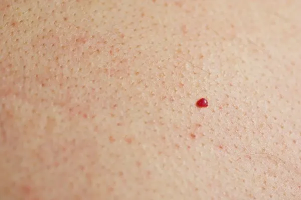 close up of a cherry angioma Kent