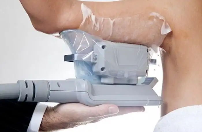 Picture of fat freezing Kent on the upper arms.