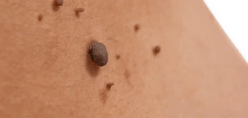 image of a skin tag Kent