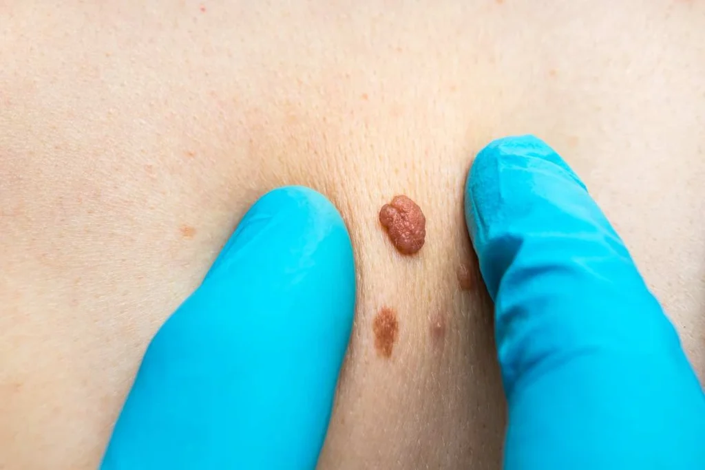 Consultant examining a skin tag Kent