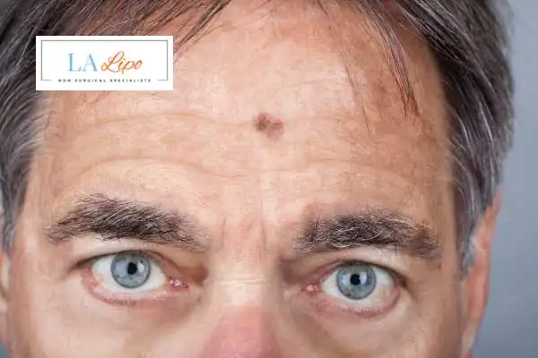 Solar Lentigo Removal Kent image of man with mark on his forehead