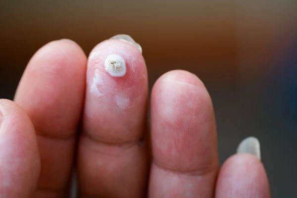 wart on person finger - cryotherapy to treat from LA LIPO Kent