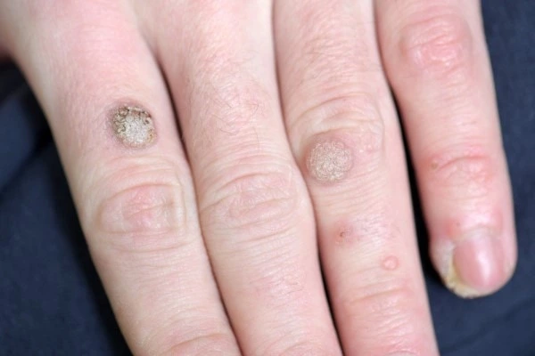 photo of warts on person hand - see wart removal Kent from LA LIPO