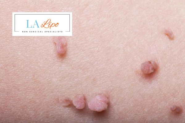 Does cryopen skin tag removal Kent hurt? Find out now call our team today!