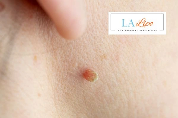 Book skin tag removal Kent today speak to our team now!