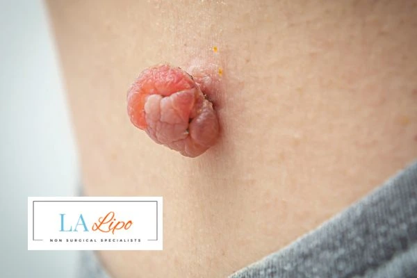 Interested in skin tag removal Kent? Concerned about the pain? Find out more today!