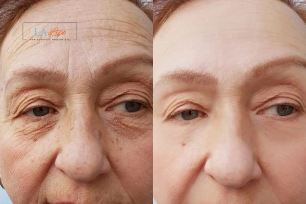 The powerful benefits of Morpheus8 Treatment Kent - Call Our team today!