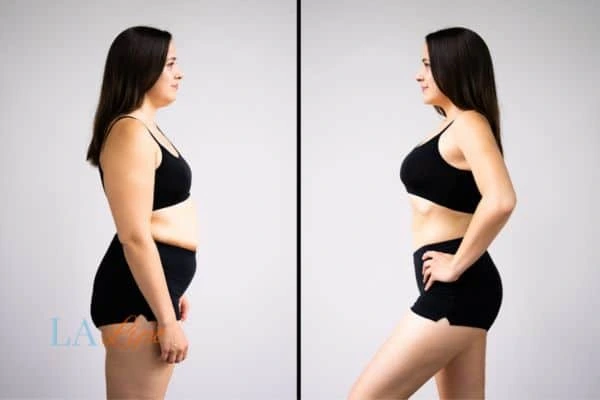 Picture of womans before and after using LA-EMS body sculpting to improve her core strength Kent