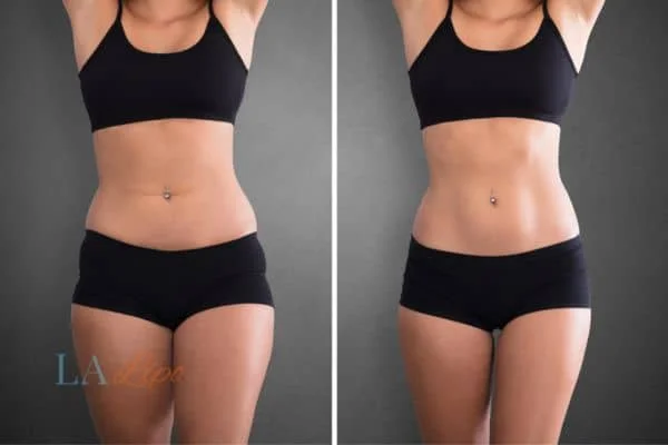 before and after results of non-surgical treatment to help a woman's body image and mental health Kent