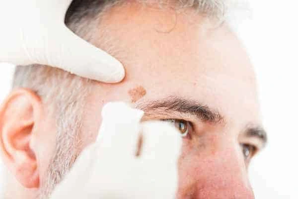 Age spots and elderly people Kent what is the link?