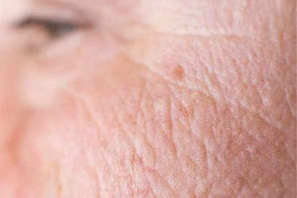 close up picture of a woman's face showing an age spot Kent
