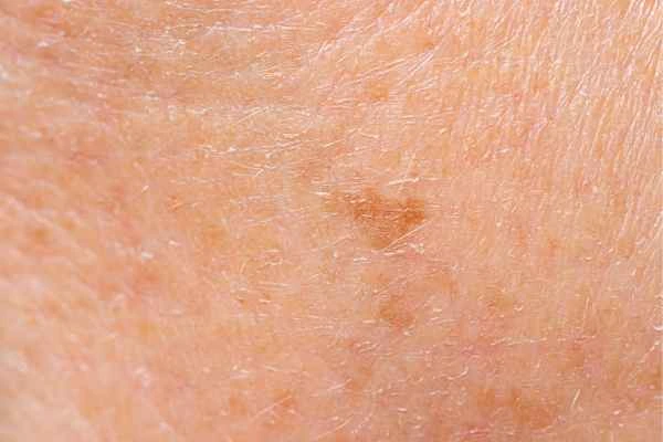 close up picture of age spots Kent