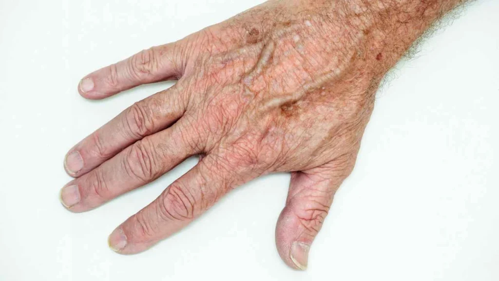 Male hand showing age spot Kent