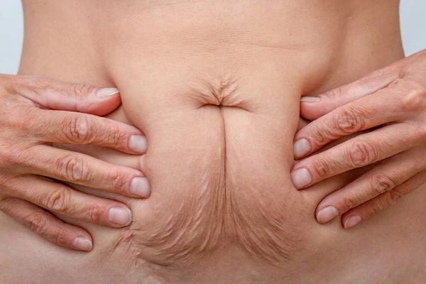 Image of a woman's stomach with loose skin - example of skin tightening Kent options