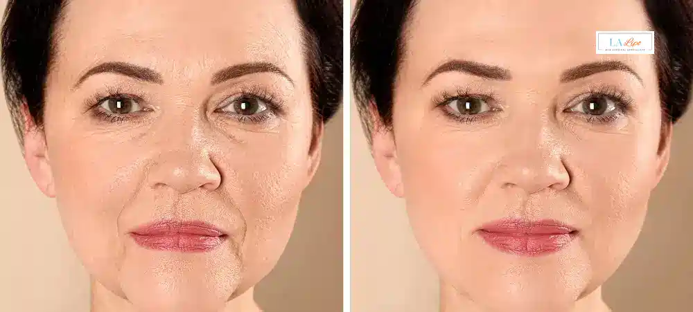 How Long Does It Take to See Results and How Long Do They Last Kent?