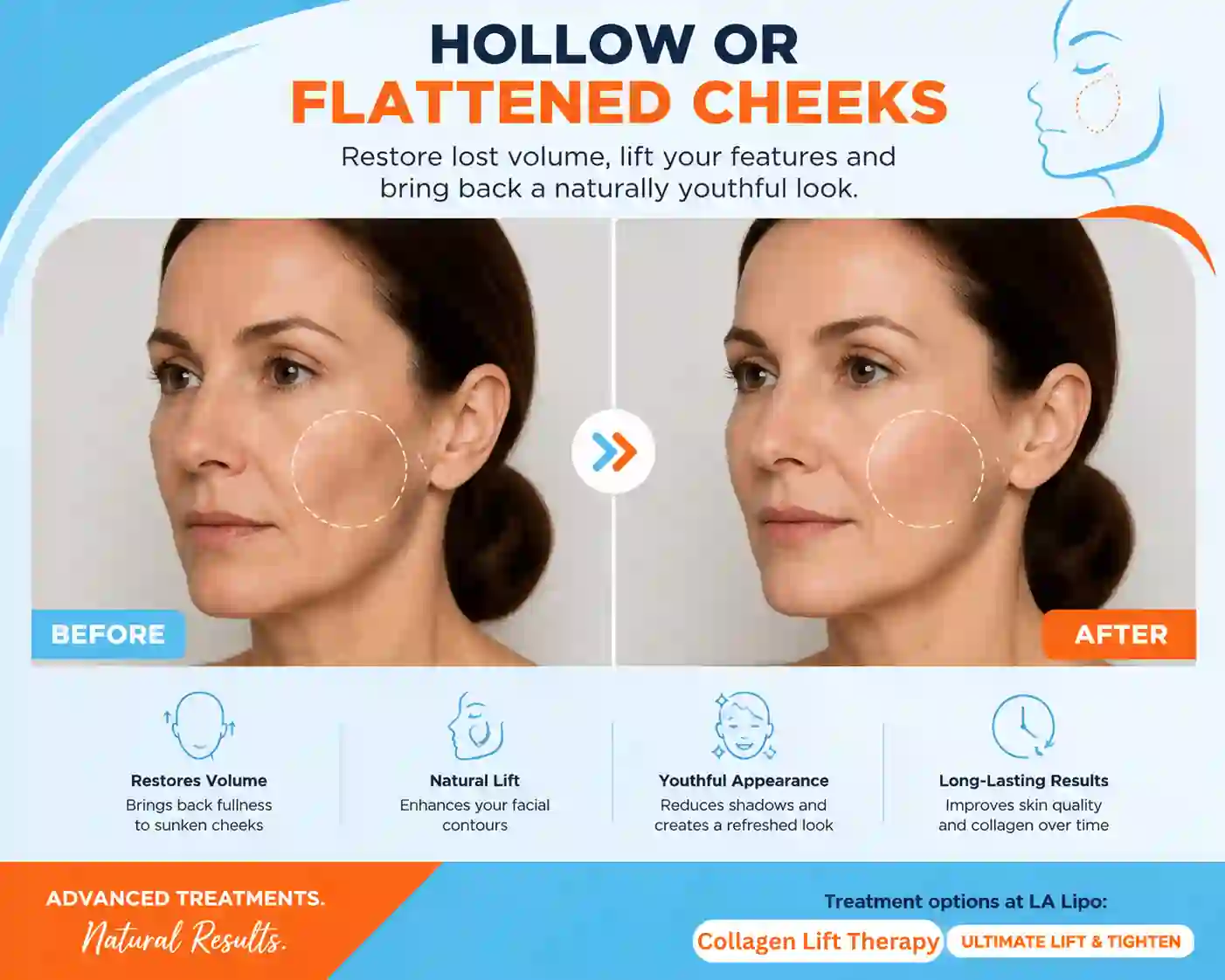 Sign #4: Hollow or Flattened Cheeks Kent