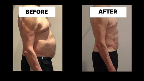 What Symptoms Can Diastasis Recti Cause in Men? Weak Core, Back Pain and Poor Posture Kent